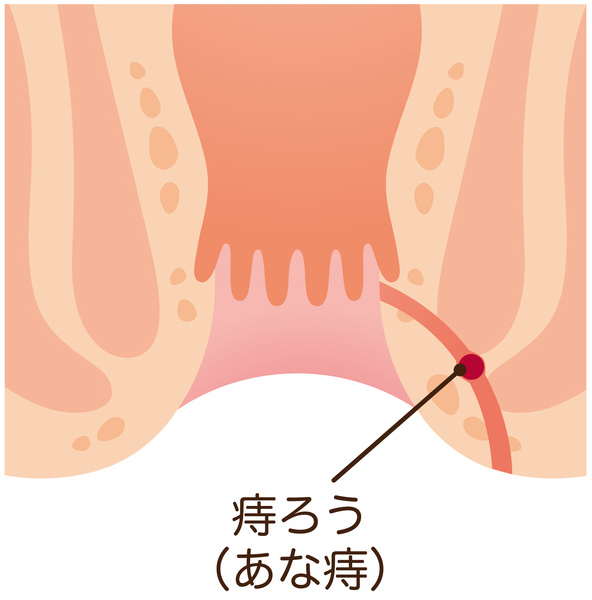 肛門周囲膿瘍 痔ろう 岡山市 肛門科 おくむら大腸肛門クリニック 麻酔下大腸内視鏡