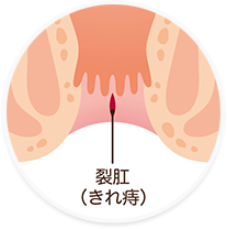 切れ痔（裂肛）