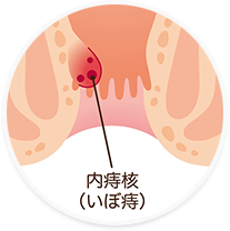 いぼ痔（痔核）