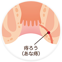 肛門周囲膿瘍/痔ろ）