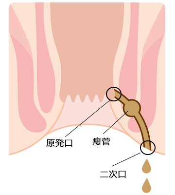 肛門周囲膿瘍 痔ろう 岡山市 肛門科 おくむら大腸肛門クリニック 麻酔下大腸内視鏡