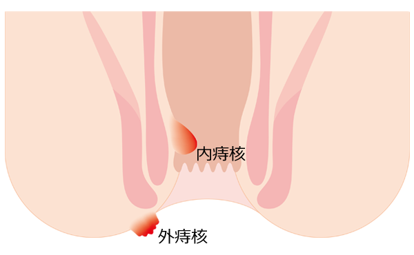 内痔核外痔核